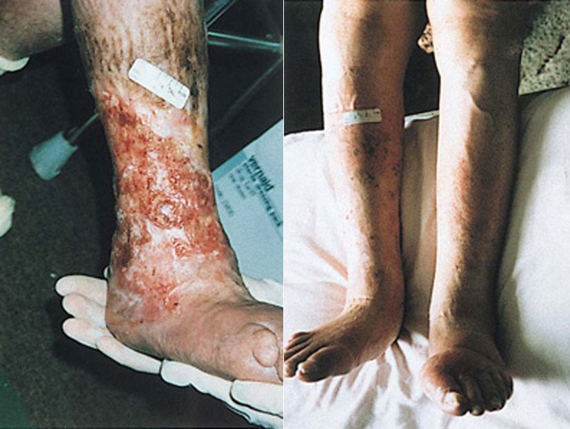 leg-ulcer-banda2.jpg